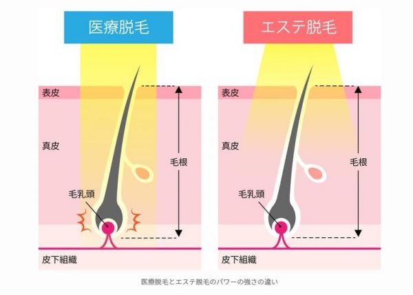 医療脱毛との違い